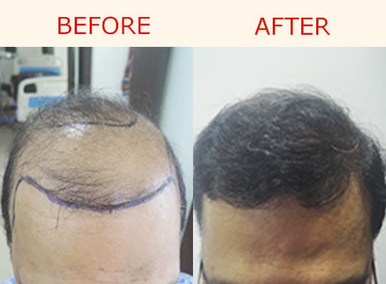 Hair Transplant in Mangalore  Reasons for not Transplanting  YouTube